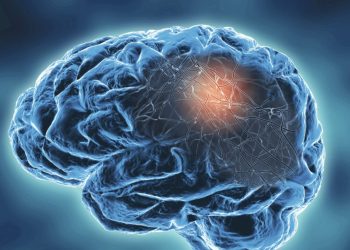 7 Signs of Early-Onset Alzheimer’s and What You Should Do