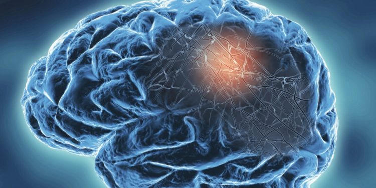 7 Signs of Early-Onset Alzheimer’s and What You Should Do